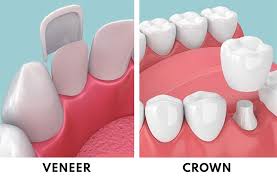 Veneers and Crowns